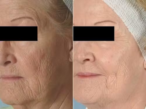Microdermabrasion Sharon Lee Beauty